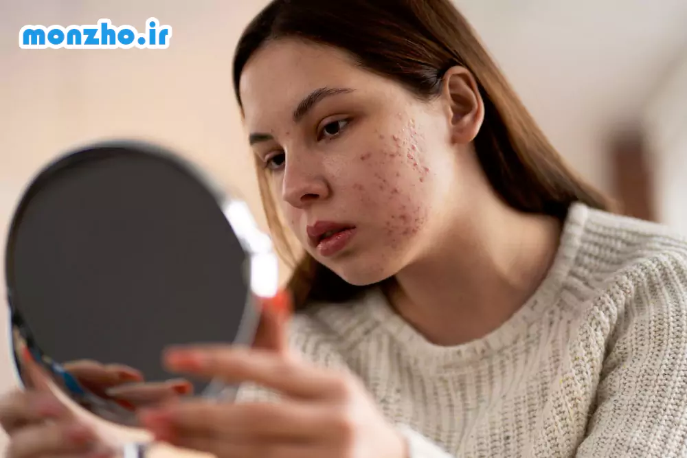چیکار کنیم جوش نزنیم؟