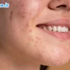ترکاندن جوش و معایب آن